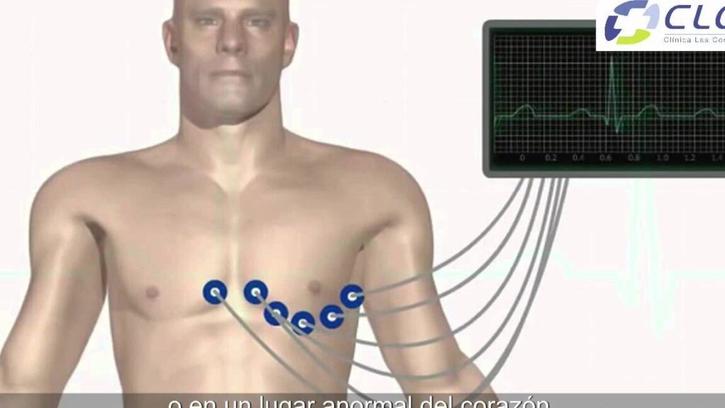 electrocardiograma explicativo